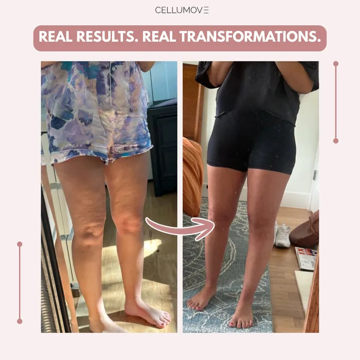 Elziq 3D Legging – Say goodbye to lipoedema pain and swelling naturally