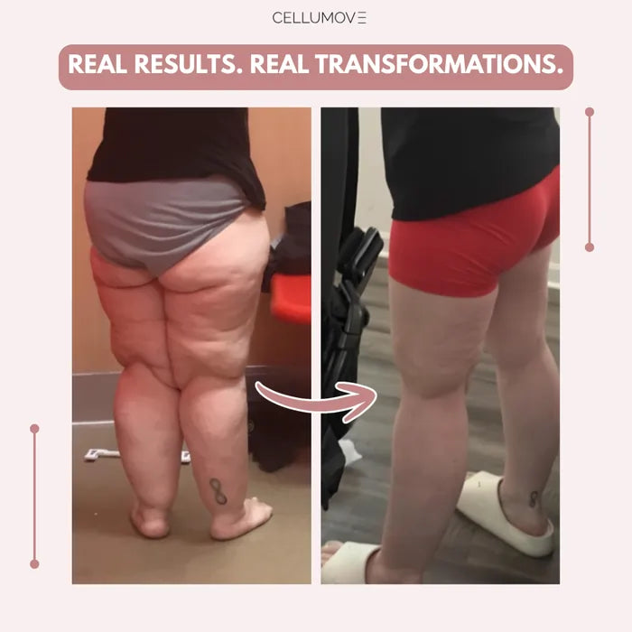 Elziq 3D Legging – Say goodbye to lipoedema pain and swelling naturally