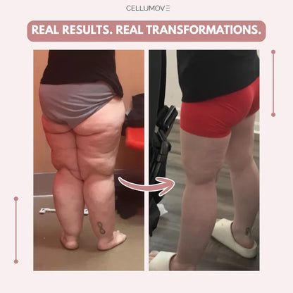 Elziq 3D Legging – Say goodbye to lipoedema pain and swelling naturally