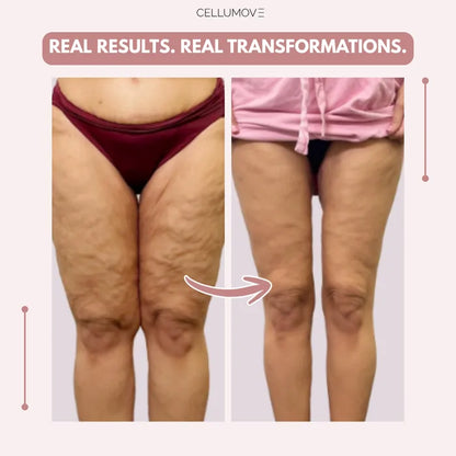 Elziq 3D Legging – Say goodbye to lipoedema pain and swelling naturally