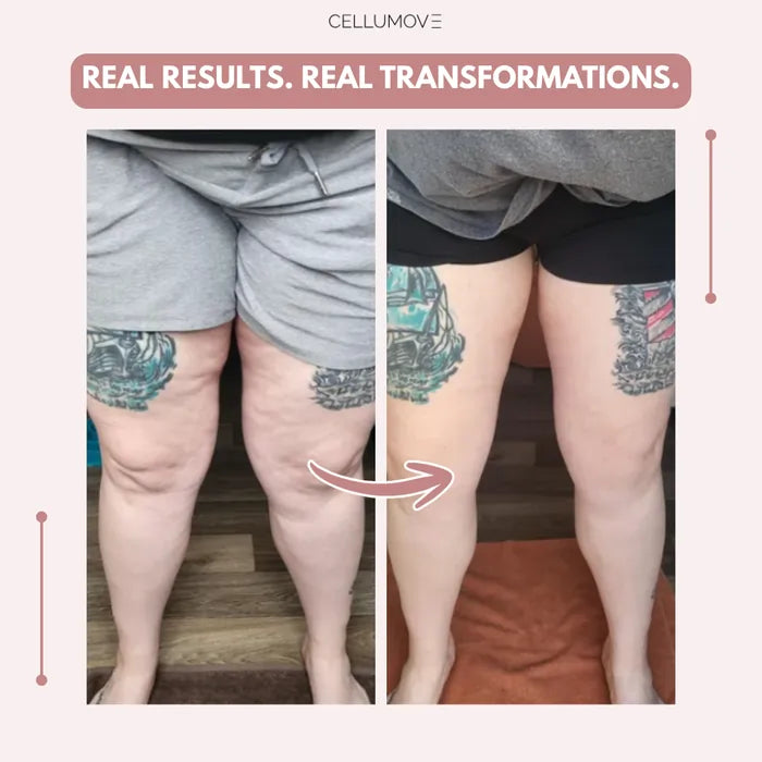Elziq 3D Legging – Say goodbye to lipoedema pain and swelling naturally
